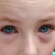 Pink Eye in Kids is Usually Mild but Often Contagious